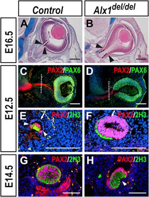 Alx1 Deficient Mice Recapitulate Craniofacial Phenotype and Reveal Developmental Basis of ALX1-Related Frontonasal Dysplasia